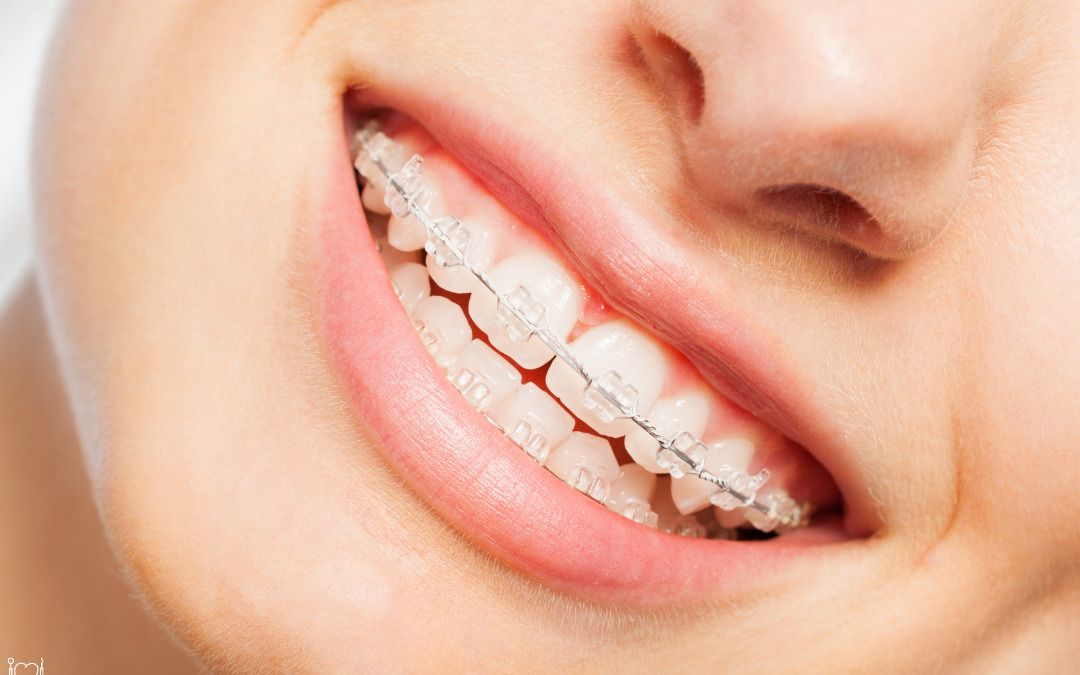 Innovative Braces Materials: Exploring Eco-Friendly Options in Dentistry