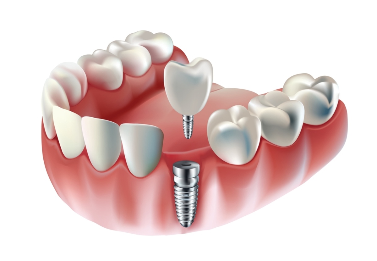 How Dental Implants Mimic Natural Tooth Root Biology to Promote Osseointegration